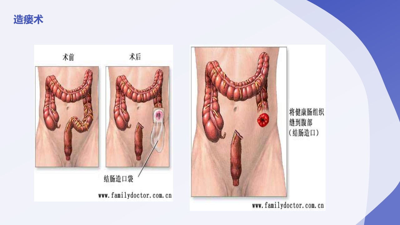 直肠造瘘术后护理PPT课件下载6