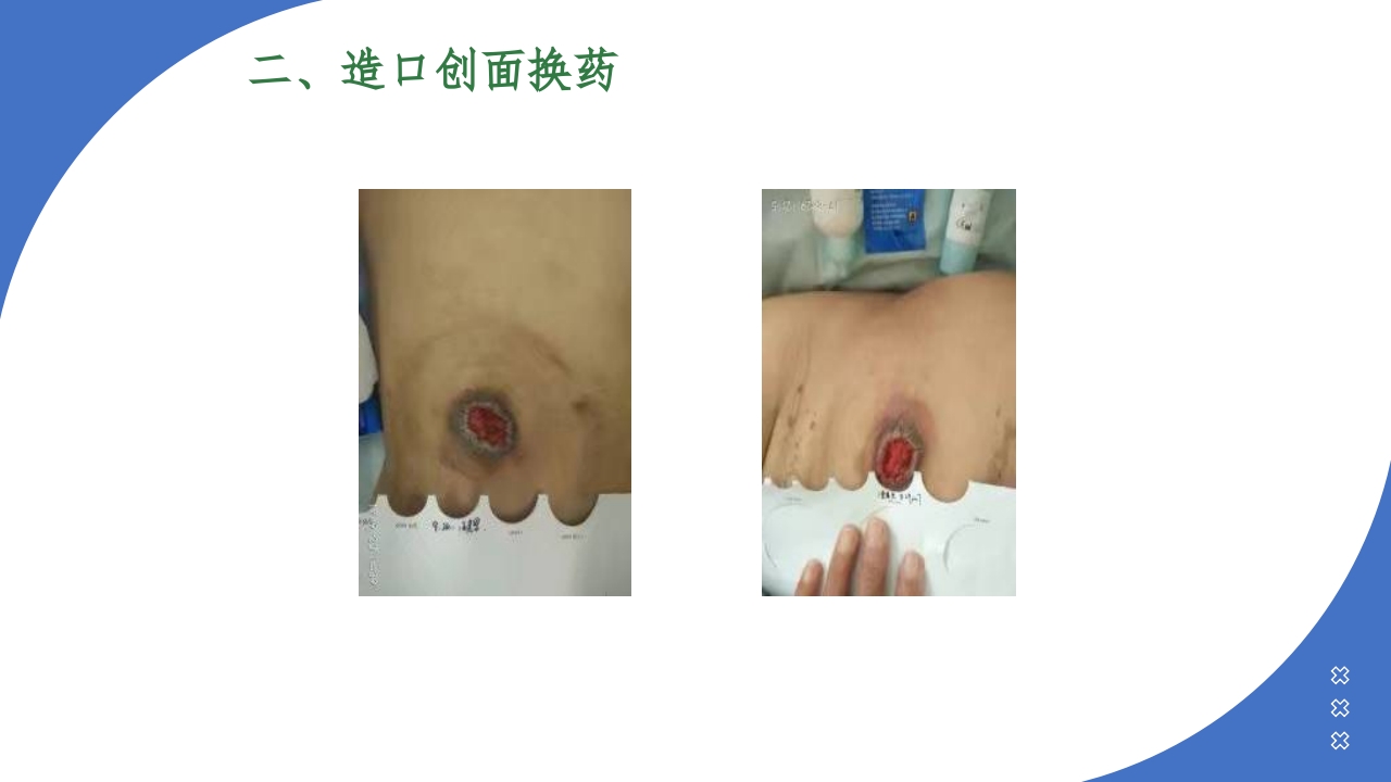 伤口造口换药PPT课件25