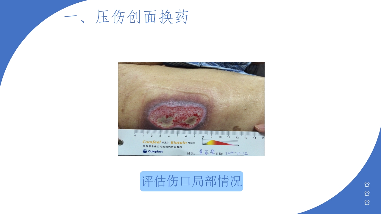 伤口造口换药PPT课件9