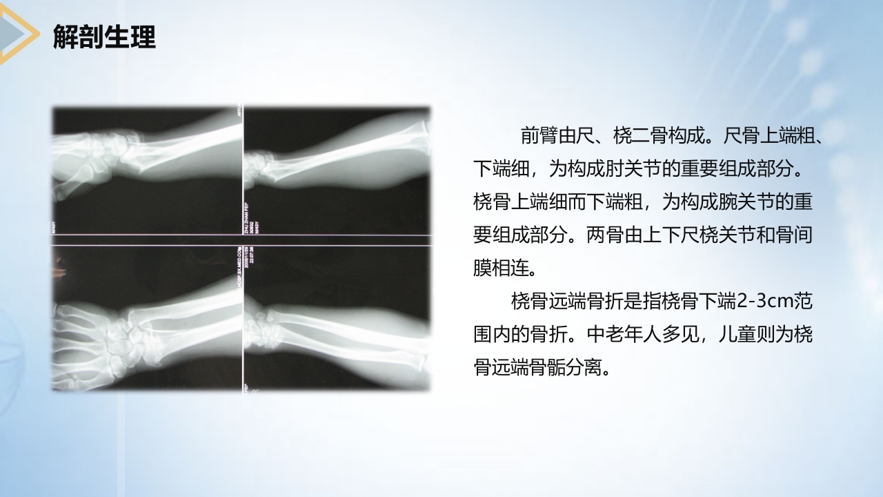 左桡尺骨双骨折的护理查房PPT课件8