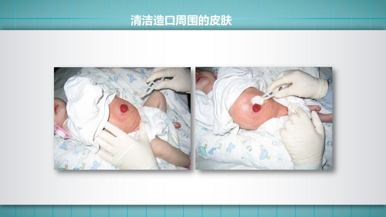 小儿肠造口护理PPT课件下载14