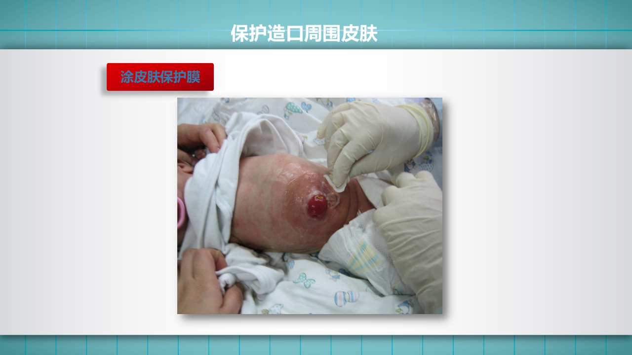 小儿肠造口护理PPT课件下载15