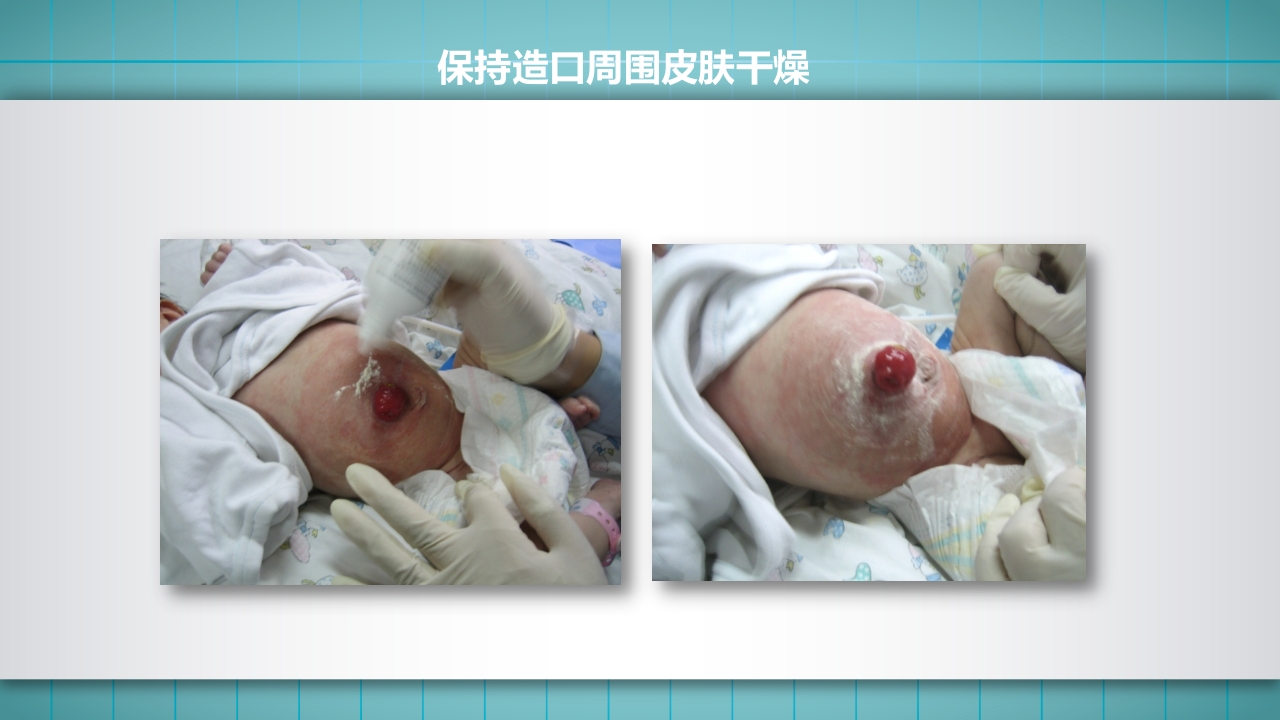 小儿肠造口护理PPT课件下载16