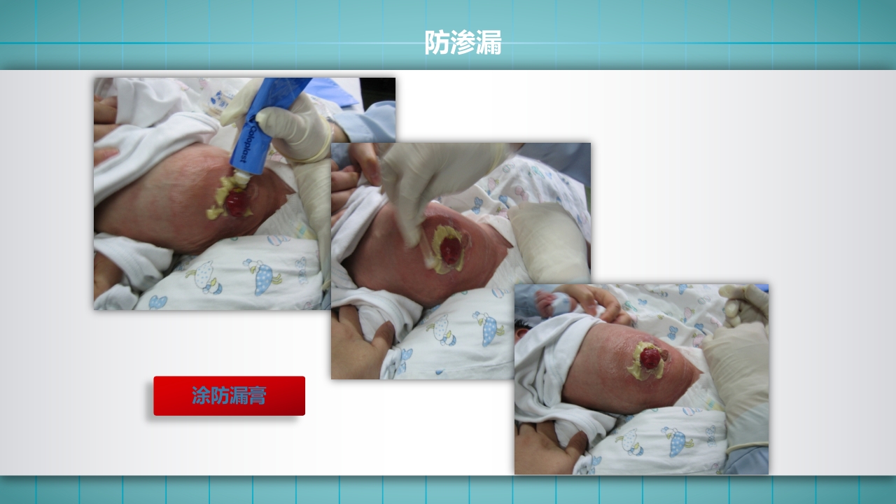 小儿肠造口护理PPT课件下载18