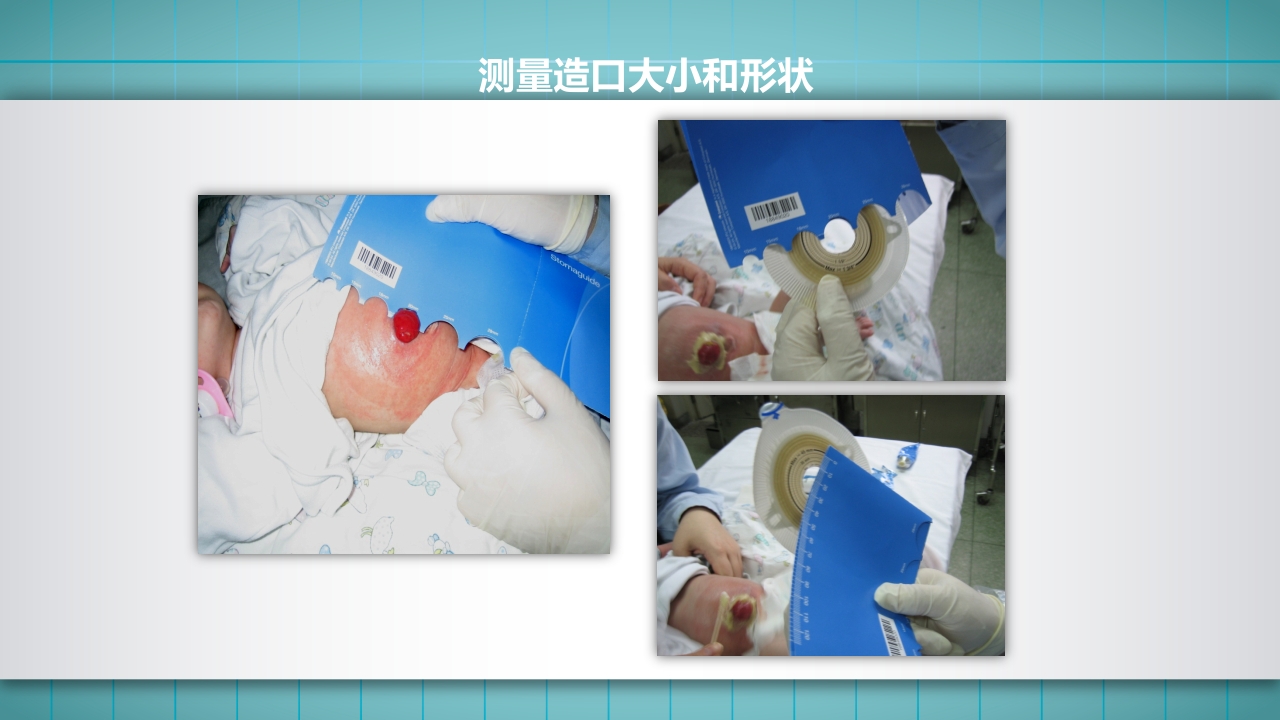 小儿肠造口护理PPT课件下载19