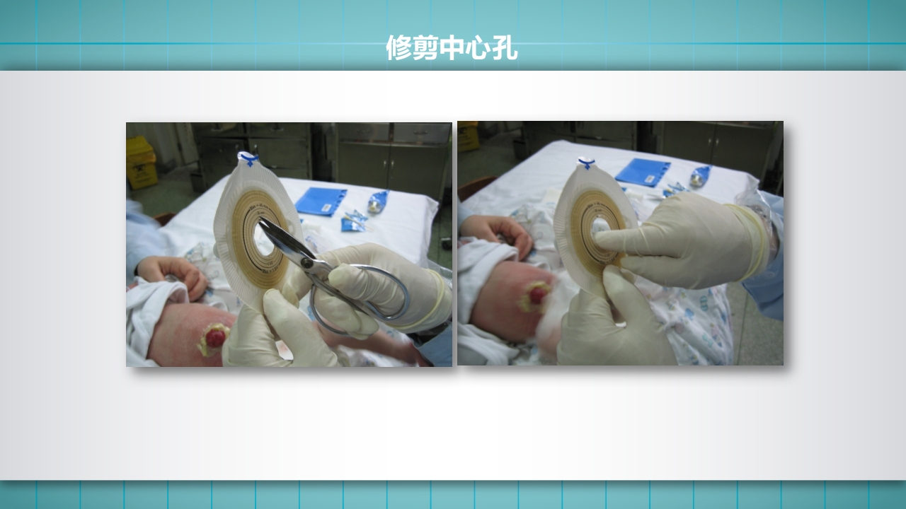 小儿肠造口护理PPT课件下载20