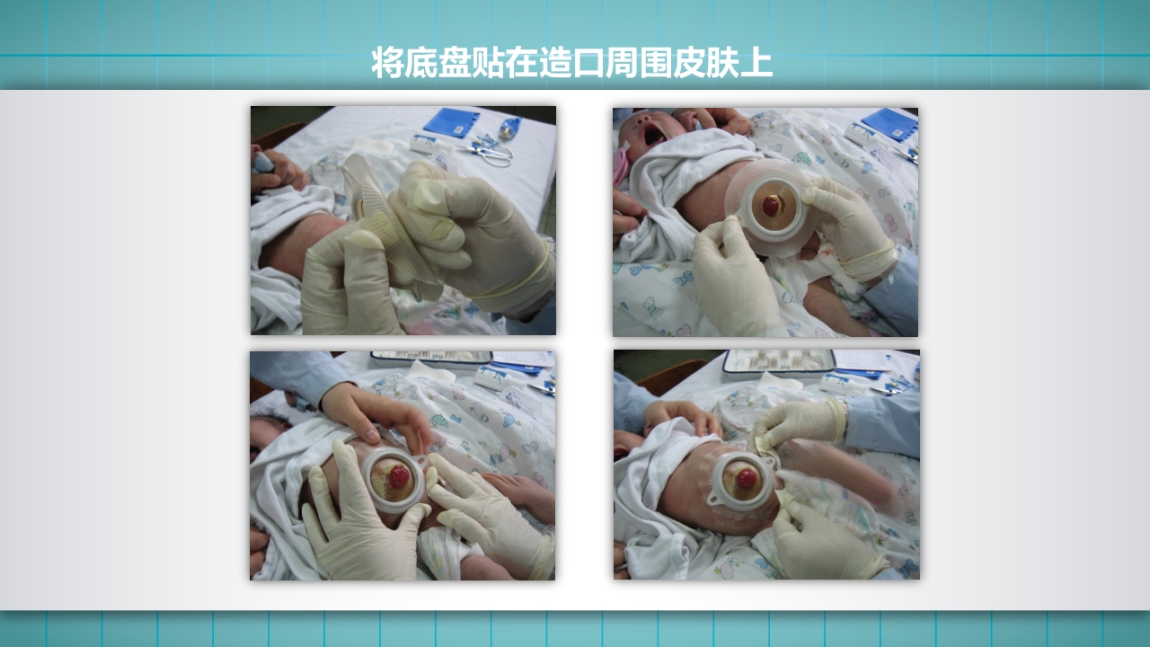 小儿肠造口护理PPT课件下载21