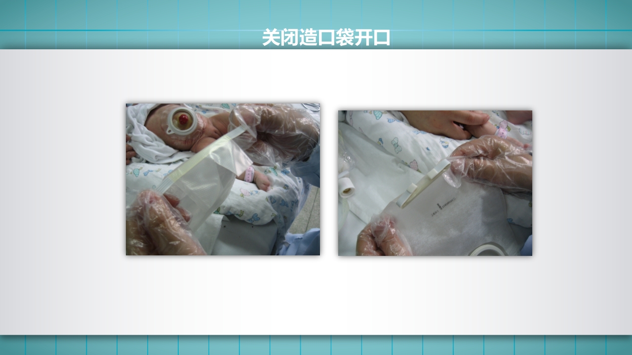 小儿肠造口护理PPT课件下载22