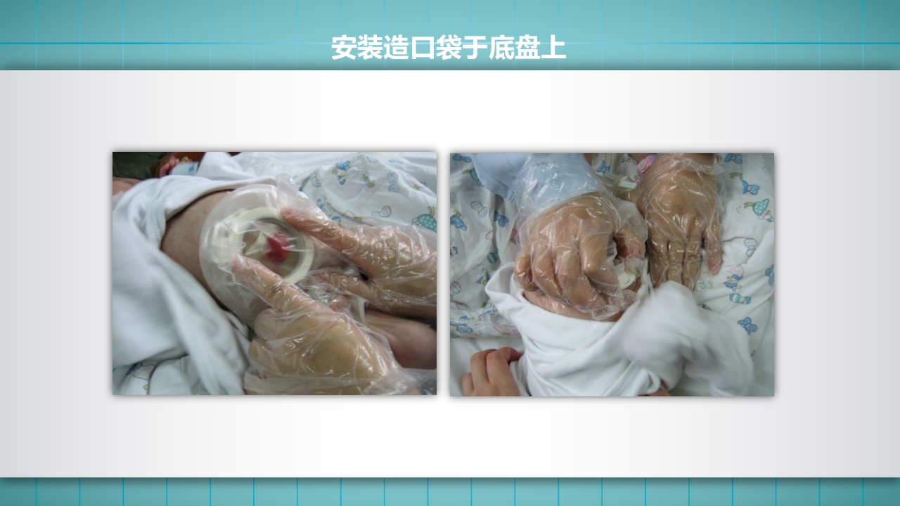 小儿肠造口护理PPT课件下载23