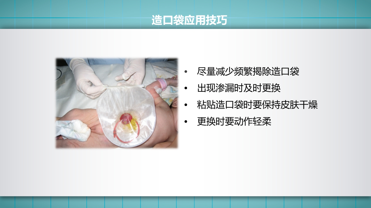 小儿肠造口护理PPT课件下载24