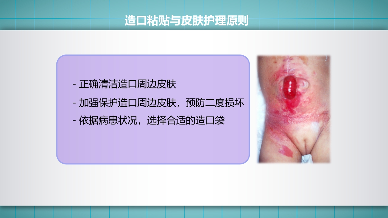 小儿肠造口护理PPT课件下载25
