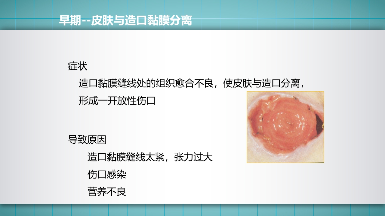 小儿肠造口护理PPT课件下载27