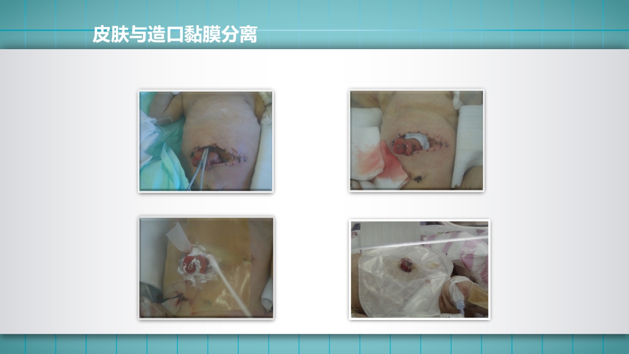 小儿肠造口护理PPT课件下载29