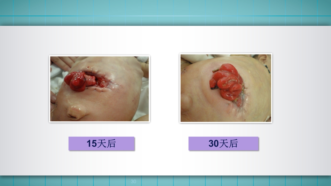 小儿肠造口护理PPT课件下载30