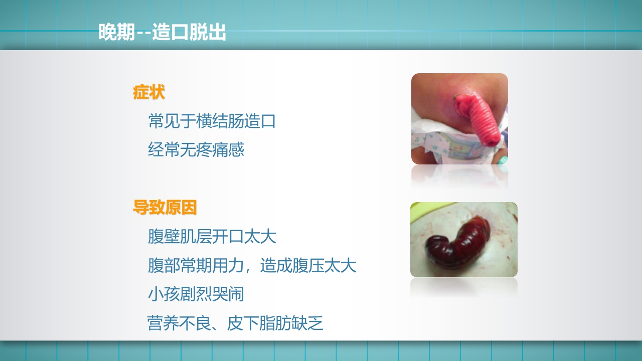 小儿肠造口护理PPT课件下载31