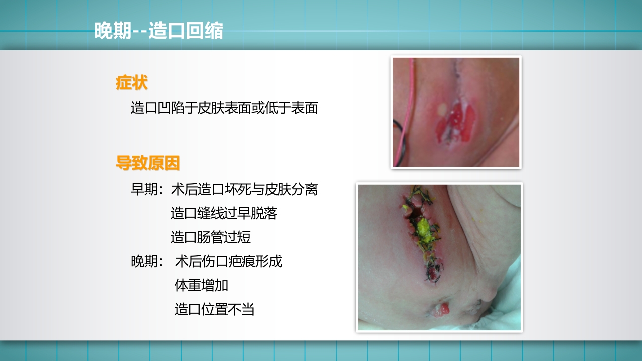 小儿肠造口护理PPT课件下载33
