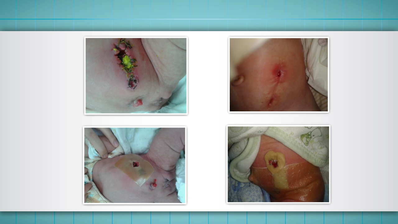 小儿肠造口护理PPT课件下载35