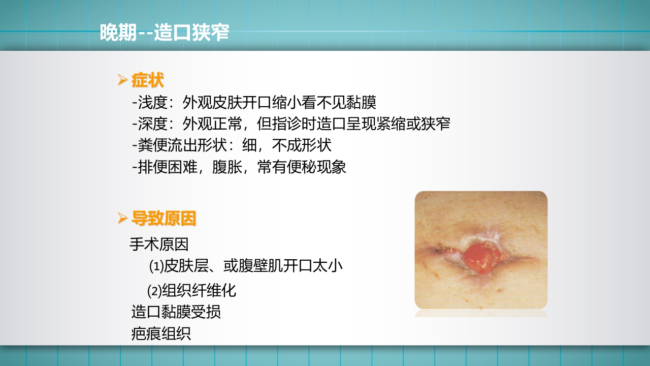 小儿肠造口护理PPT课件下载36