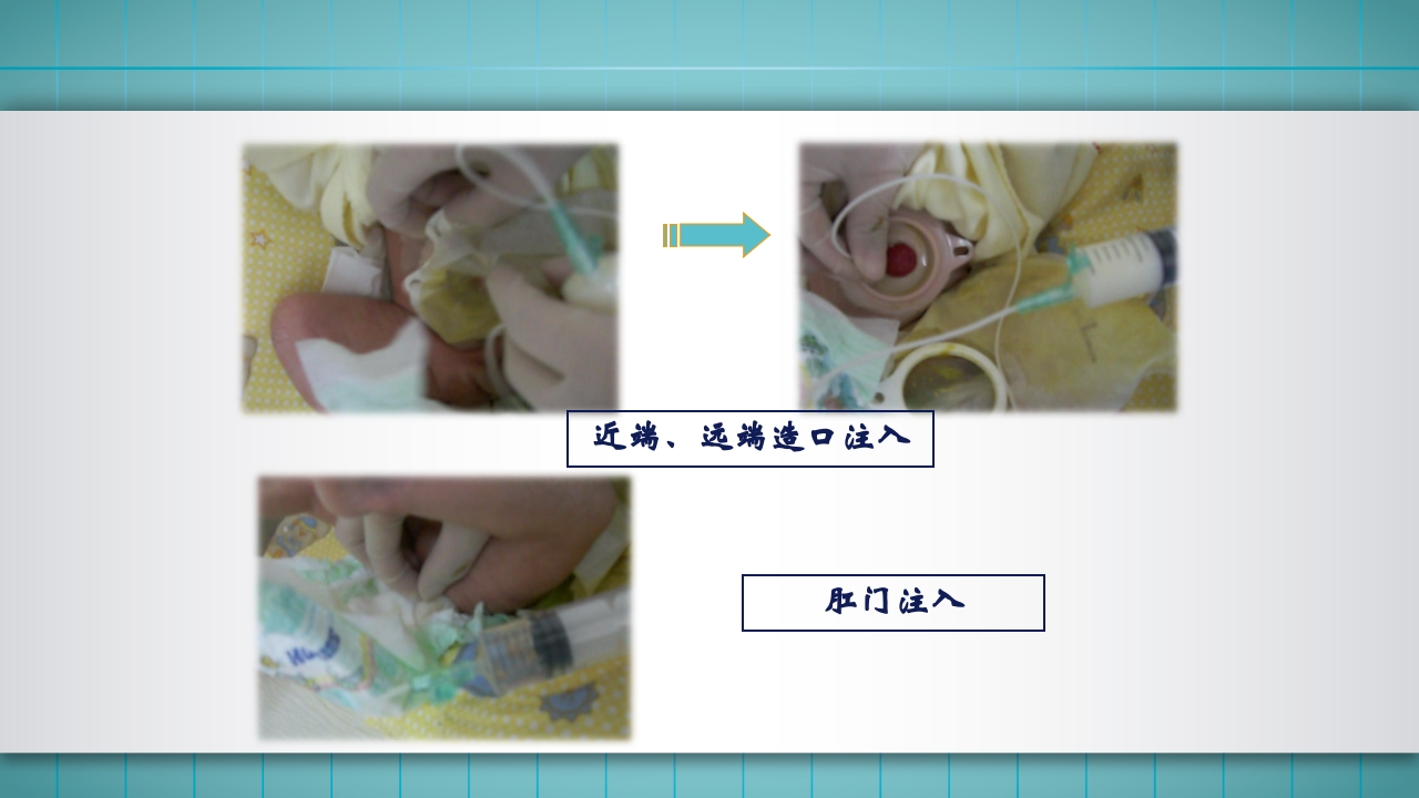 小儿肠造口护理PPT课件下载39