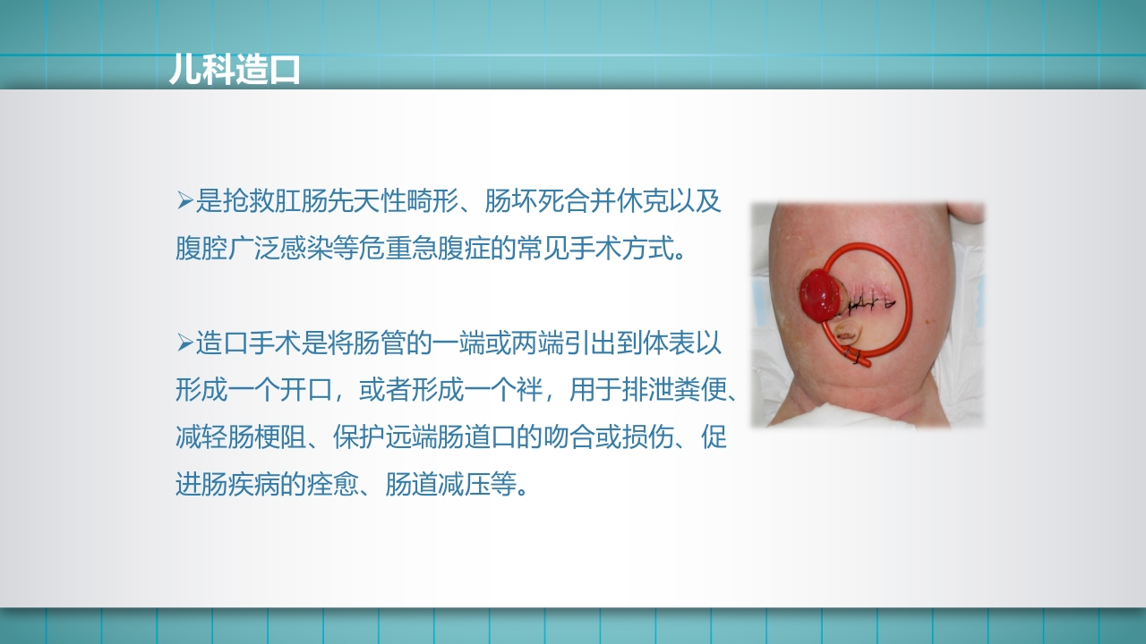 小儿肠造口护理PPT课件下载3