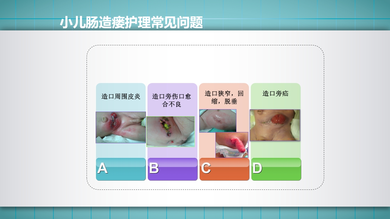 小儿肠造口护理PPT课件下载42