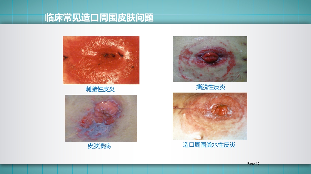 小儿肠造口护理PPT课件下载45
