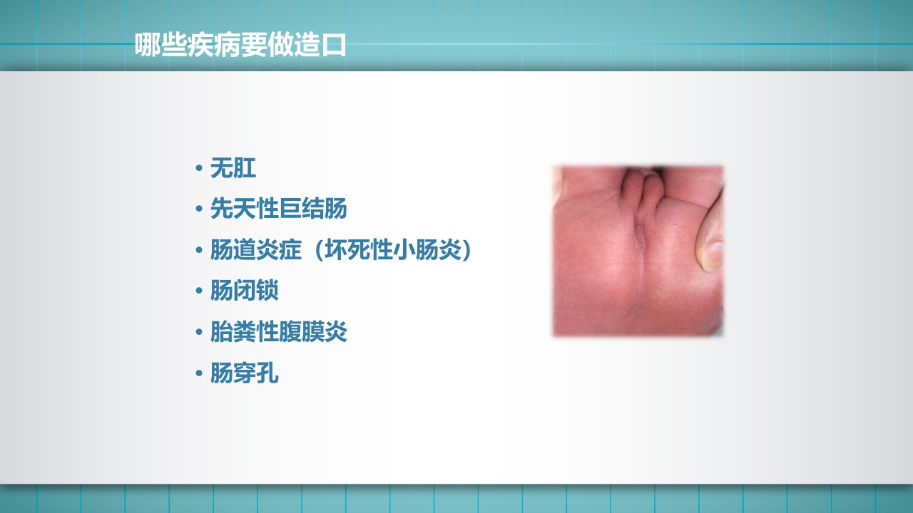 小儿肠造口护理PPT课件下载4