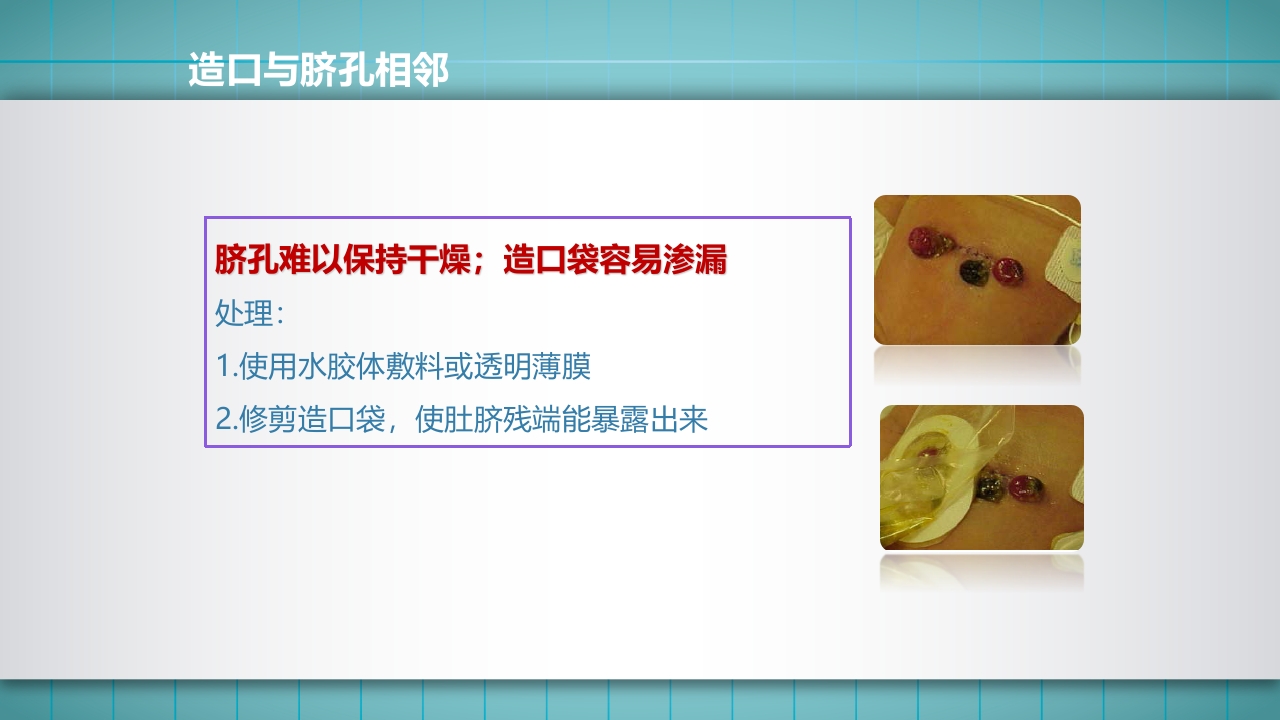 小儿肠造口护理PPT课件下载56