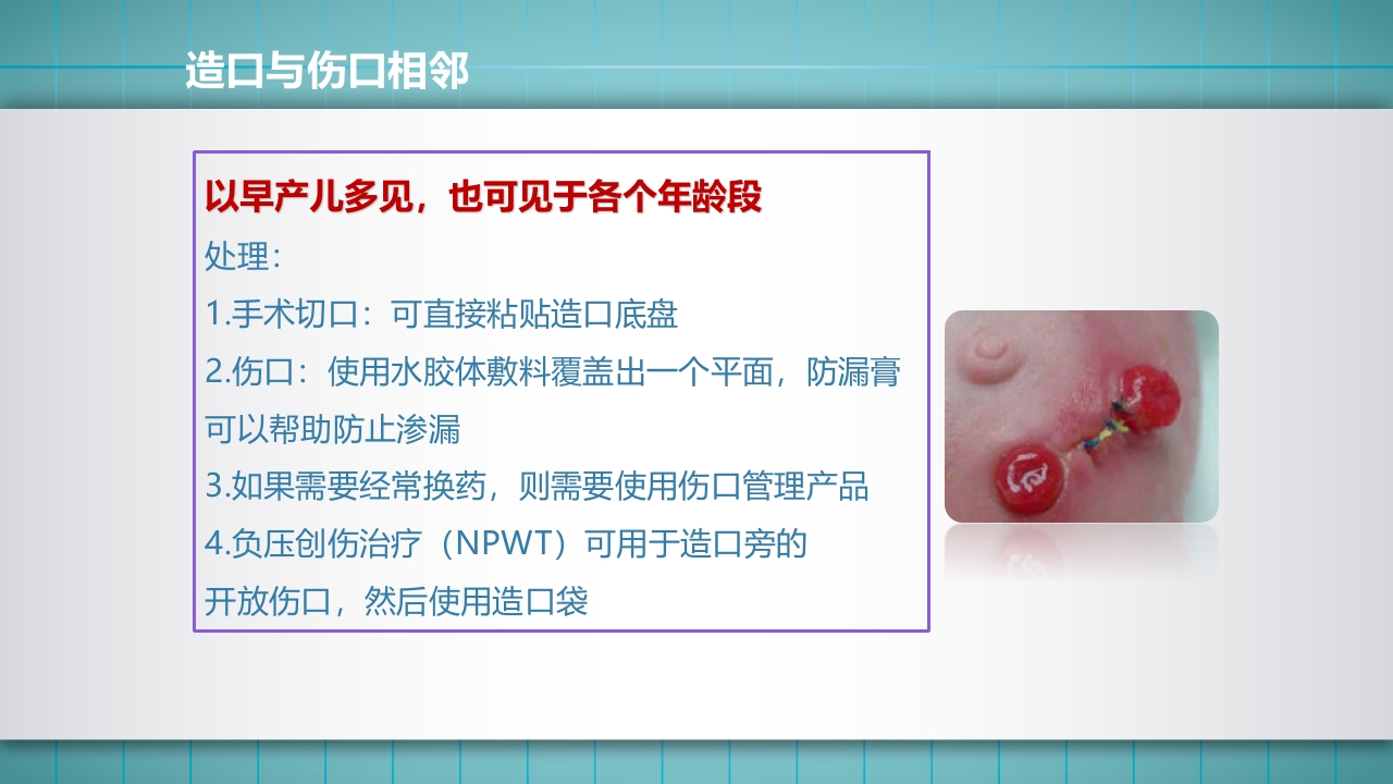 小儿肠造口护理PPT课件下载57