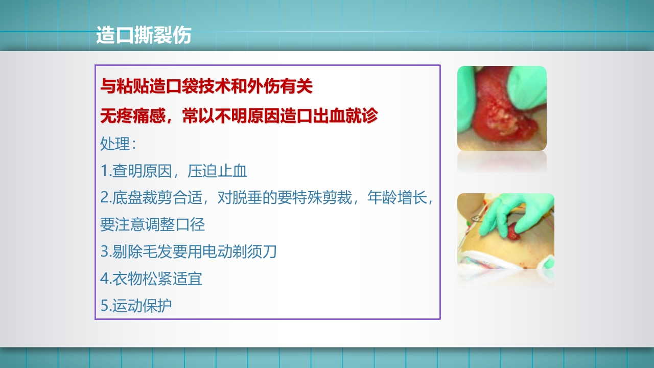 小儿肠造口护理PPT课件下载58