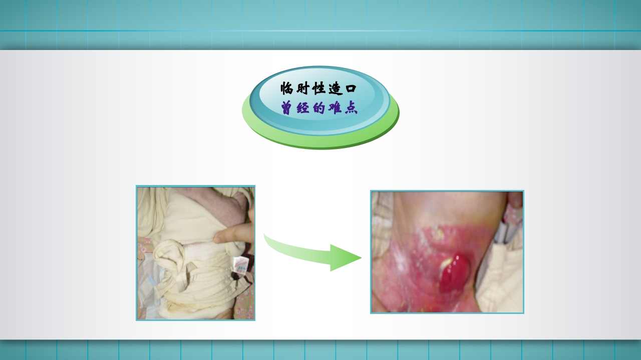 小儿肠造口护理PPT课件下载8