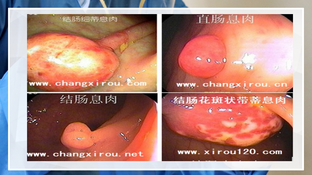 内镜下胃肠息肉切除术的护理PPT课件11