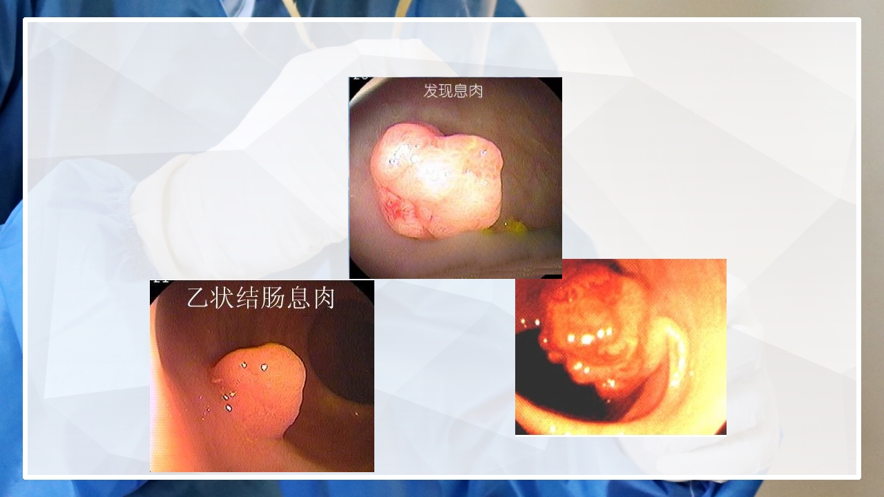 内镜下胃肠息肉切除术的护理PPT课件12