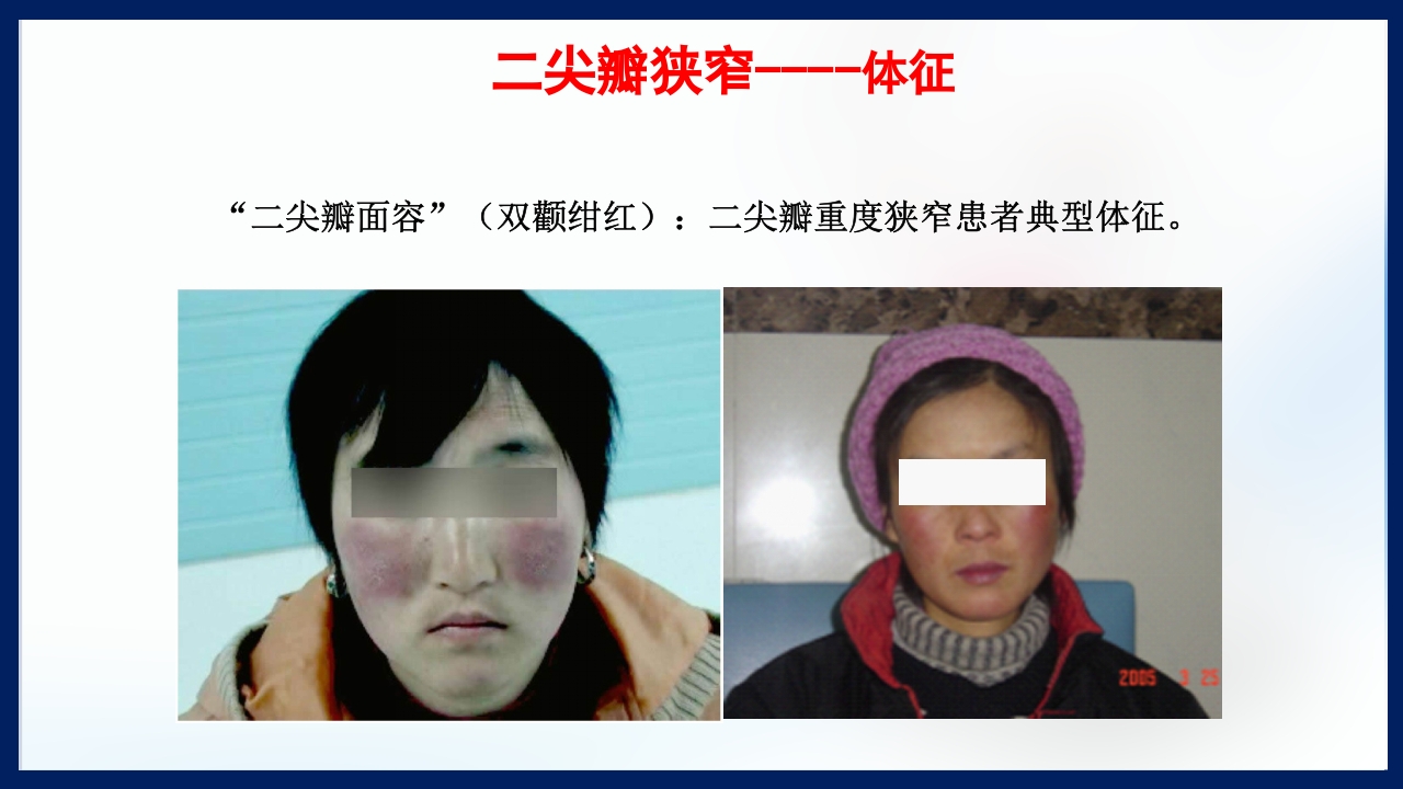 心脏瓣膜病PPT课件下载13