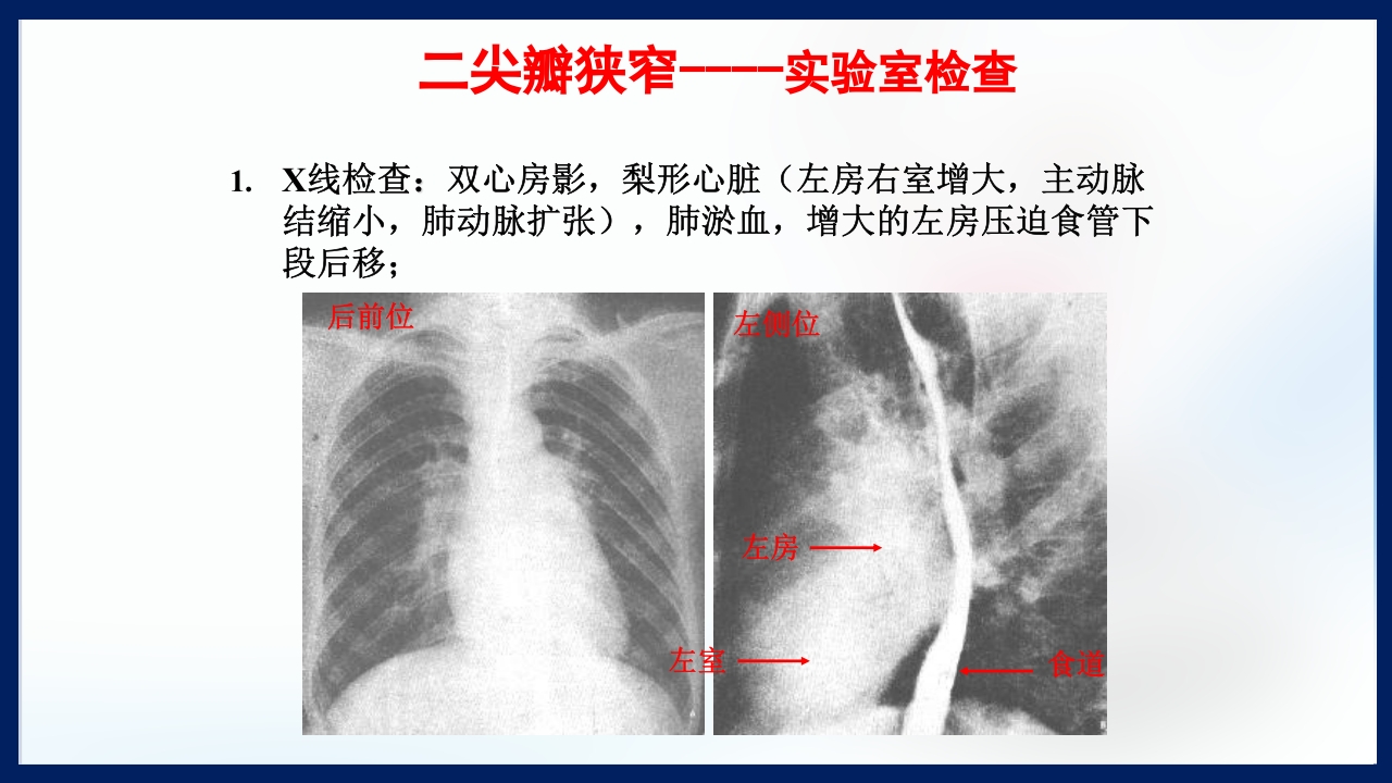心脏瓣膜病PPT课件下载17