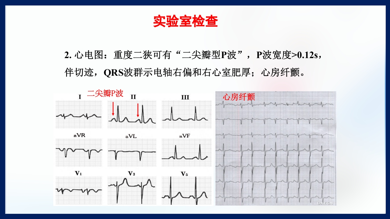 心脏瓣膜病PPT课件下载18