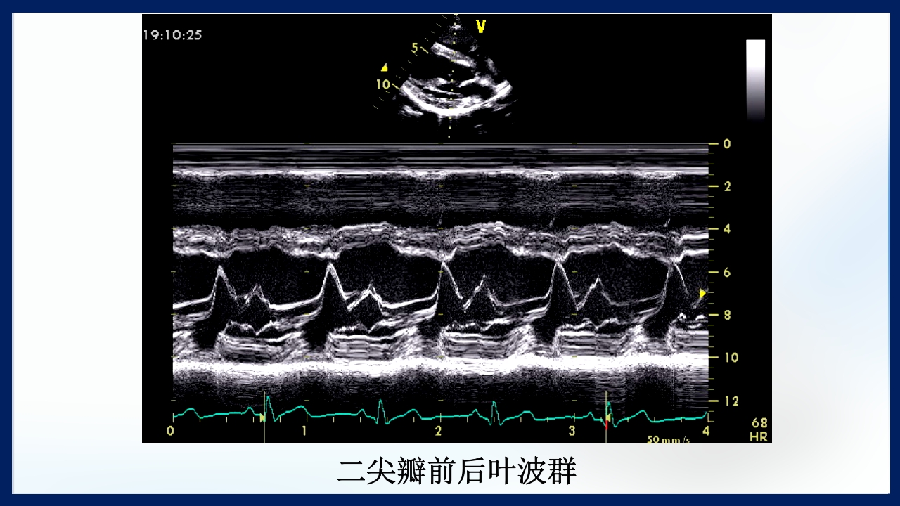 心脏瓣膜病PPT课件下载20