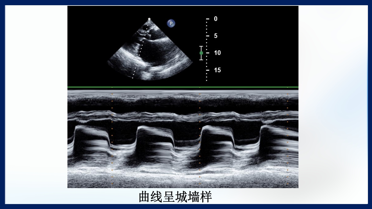 心脏瓣膜病PPT课件下载21