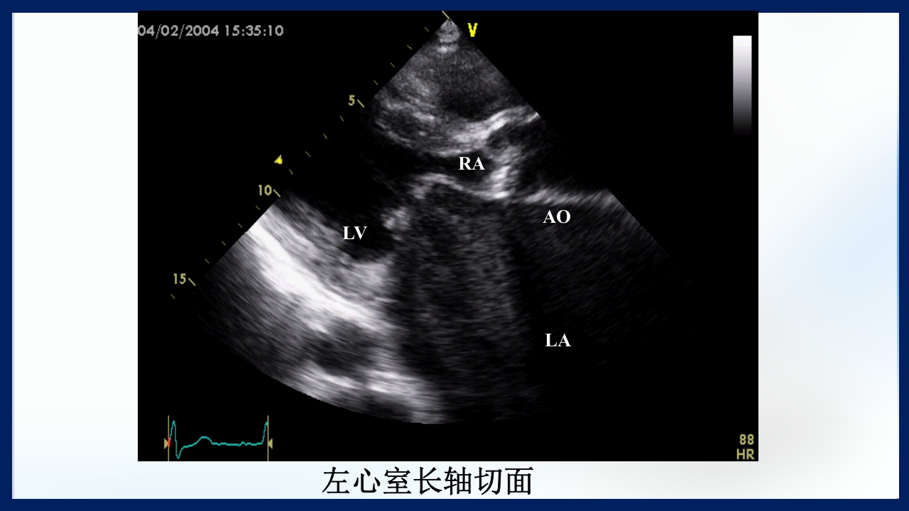 心脏瓣膜病PPT课件下载22