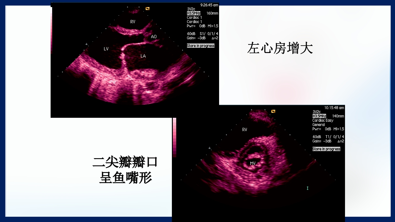 心脏瓣膜病PPT课件下载23