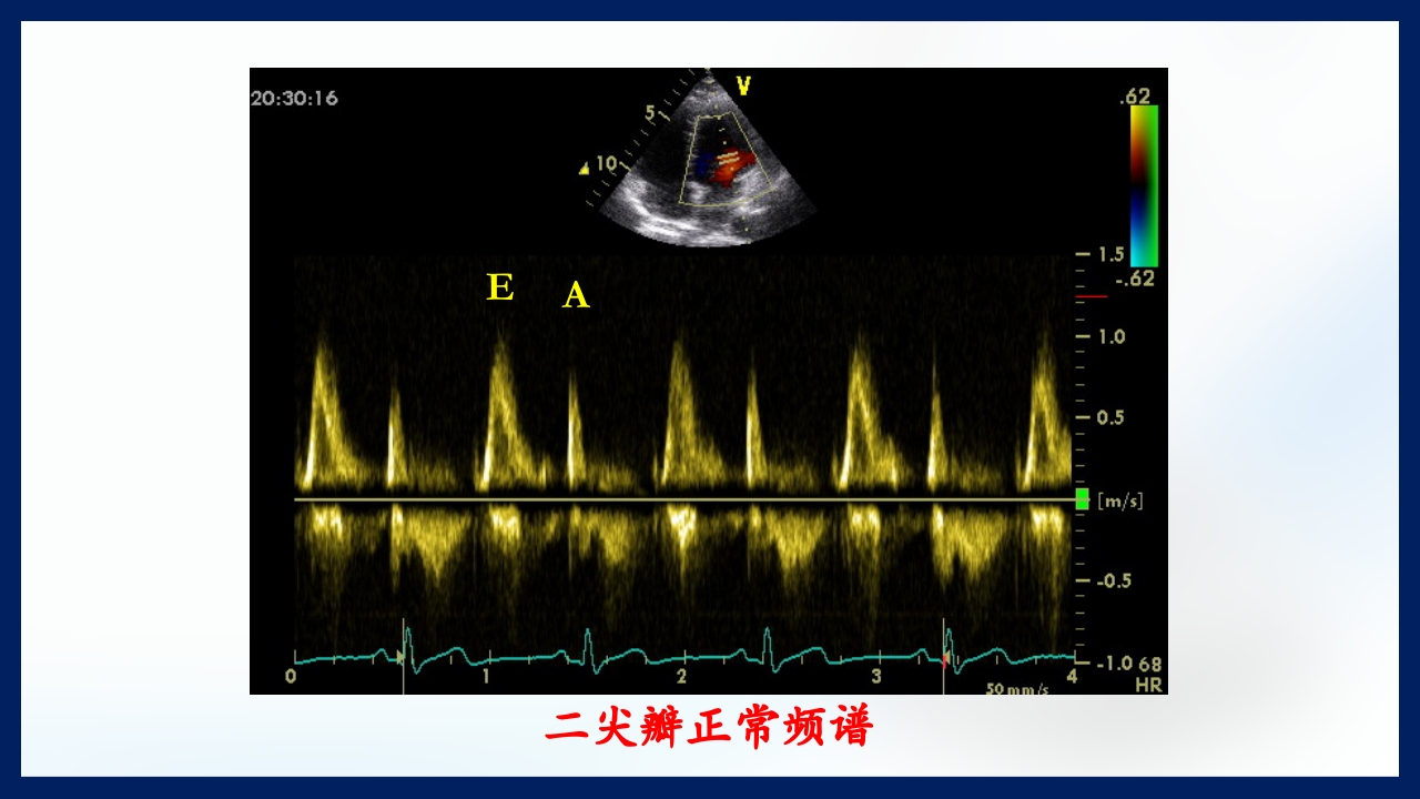 心脏瓣膜病PPT课件下载24