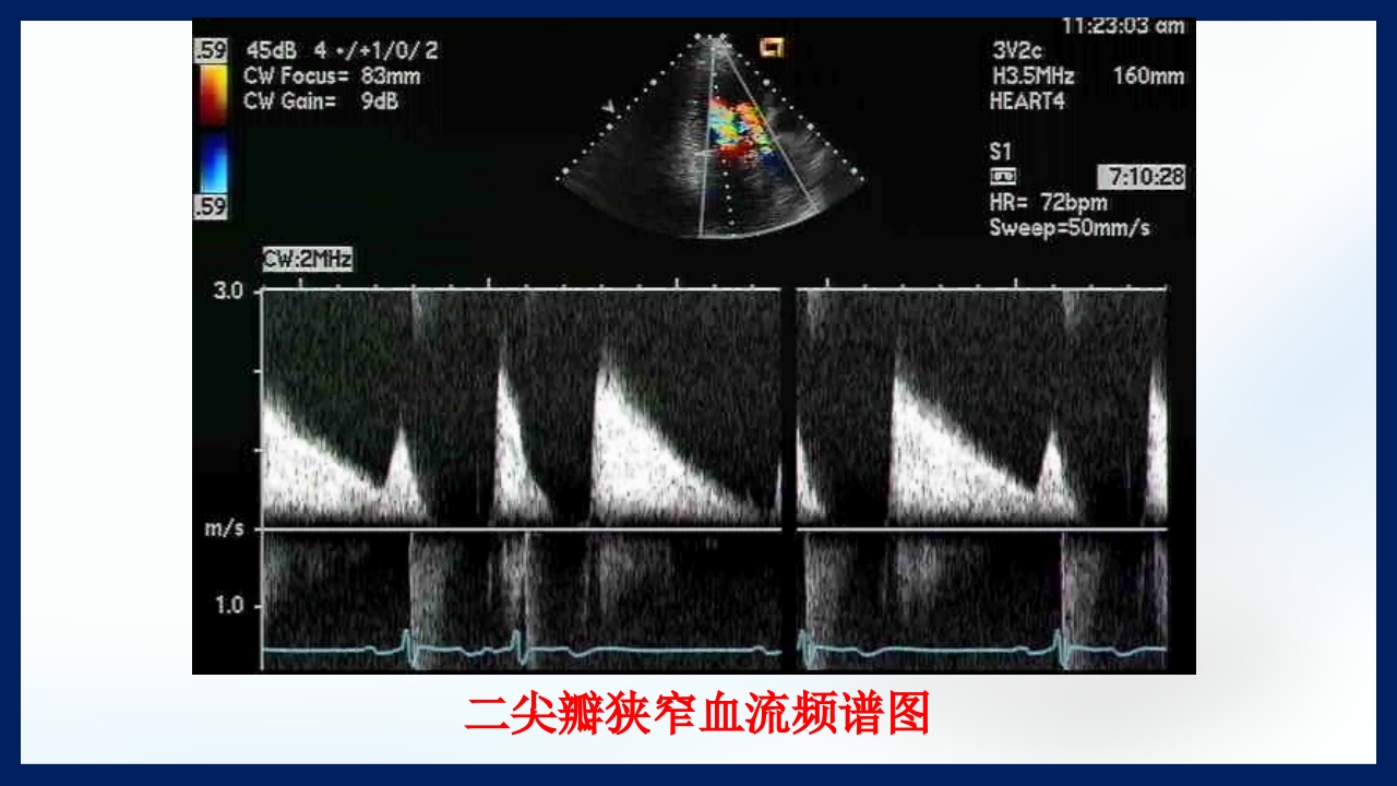 心脏瓣膜病PPT课件下载25