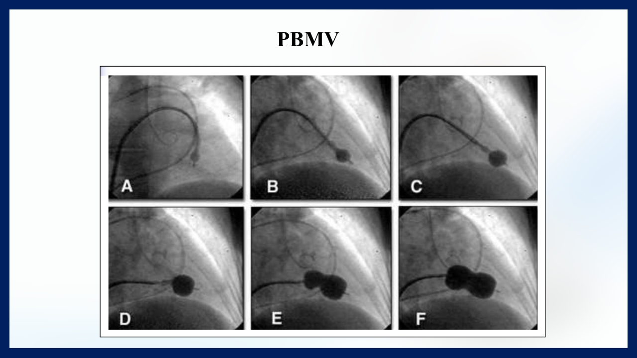 心脏瓣膜病PPT课件下载33