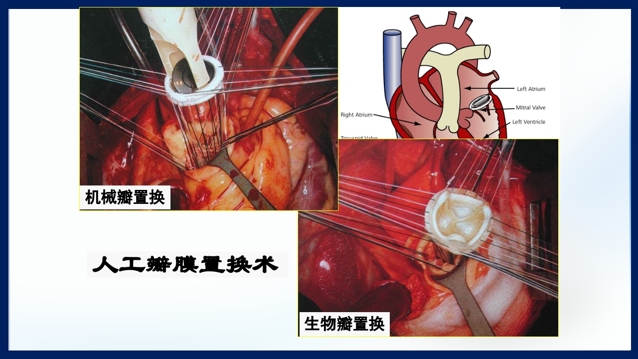 心脏瓣膜病PPT课件下载36