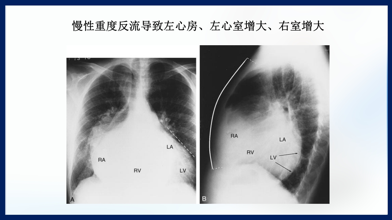 心脏瓣膜病PPT课件下载48