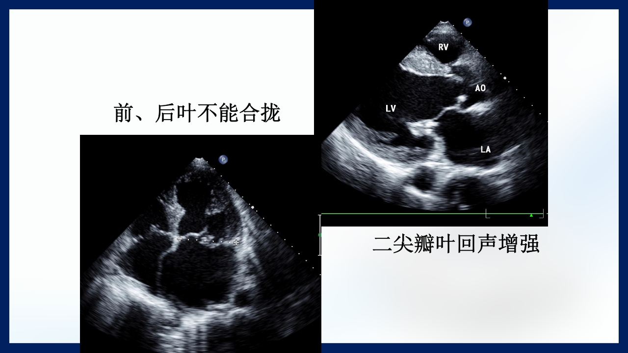 心脏瓣膜病PPT课件下载52