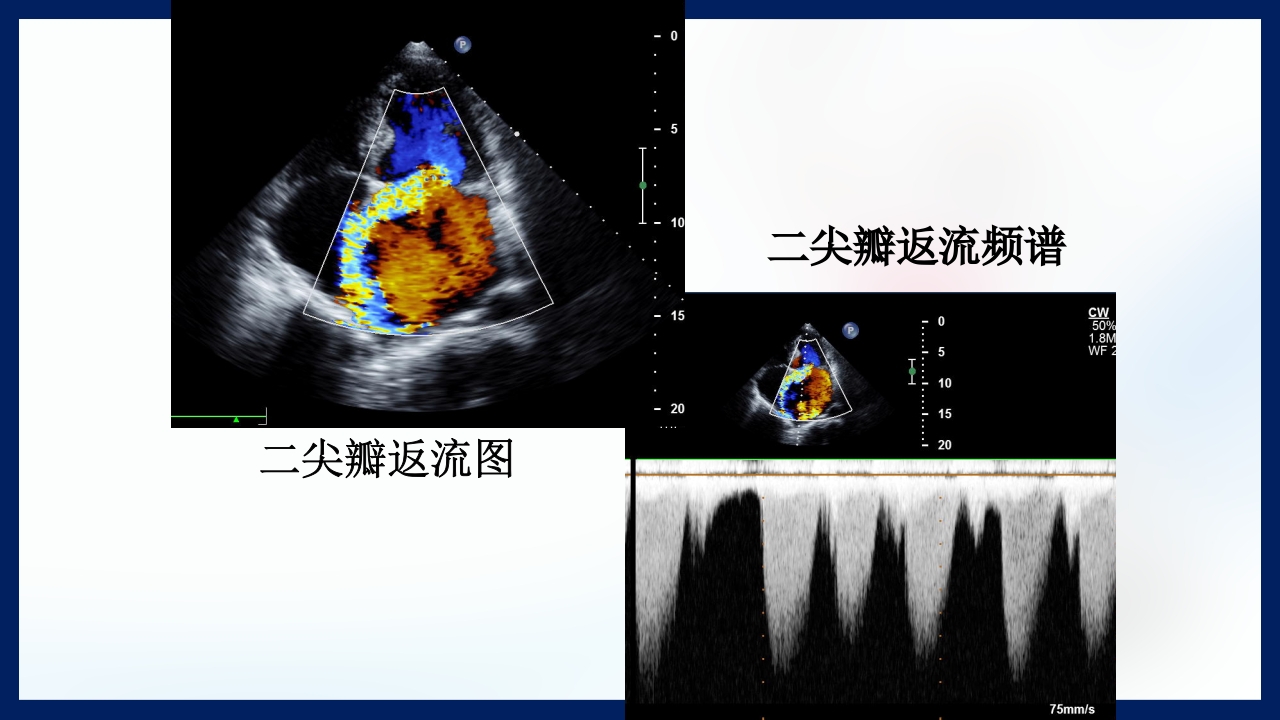 心脏瓣膜病PPT课件下载53