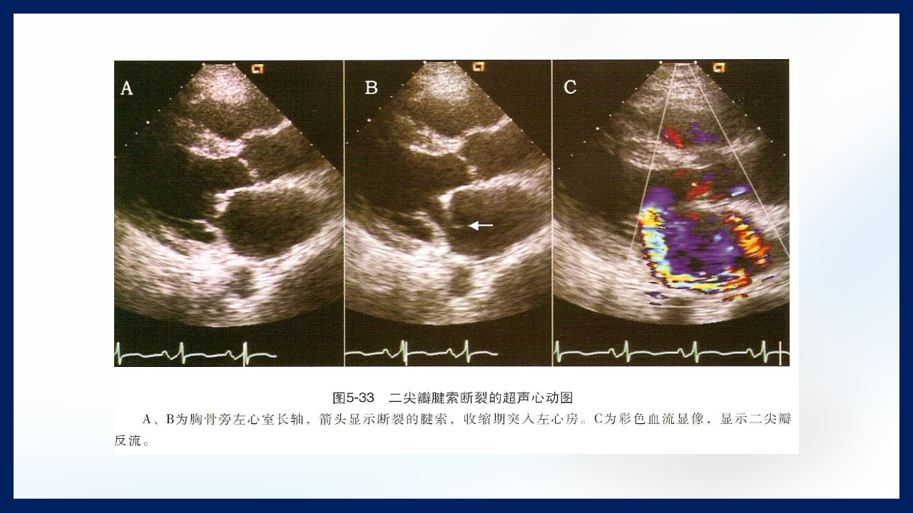 心脏瓣膜病PPT课件下载54
