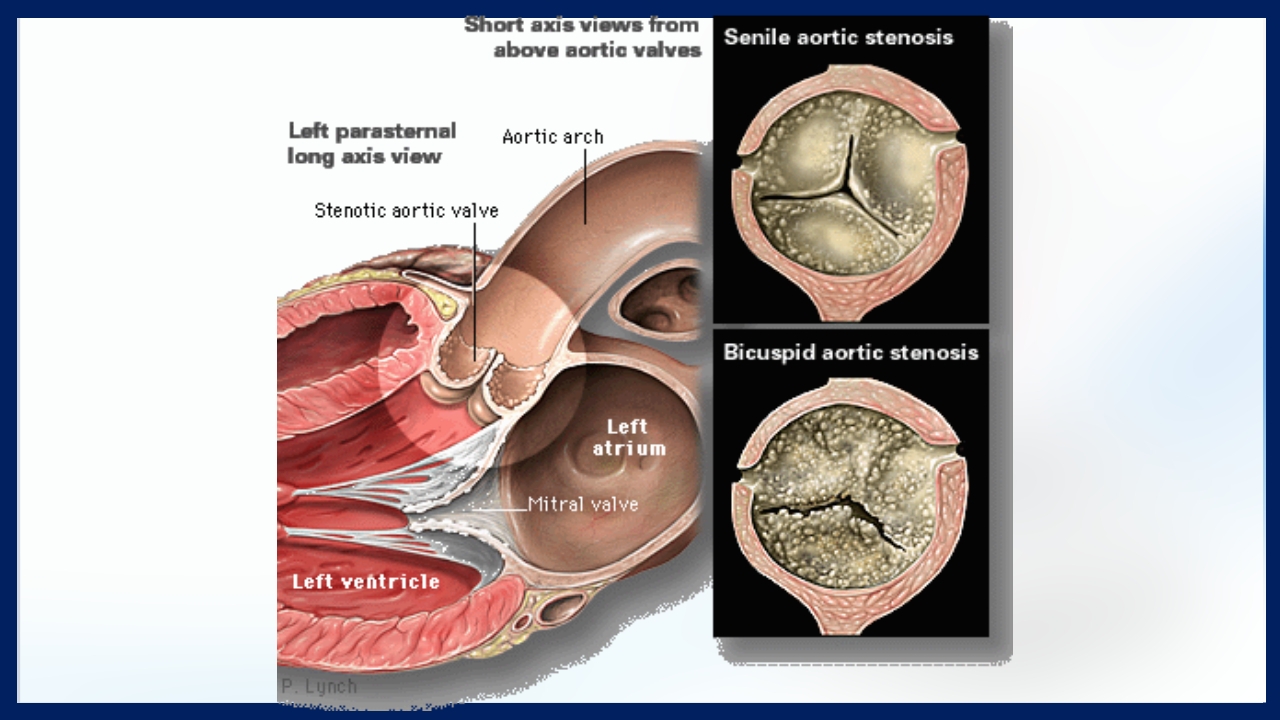 心脏瓣膜病PPT课件下载61