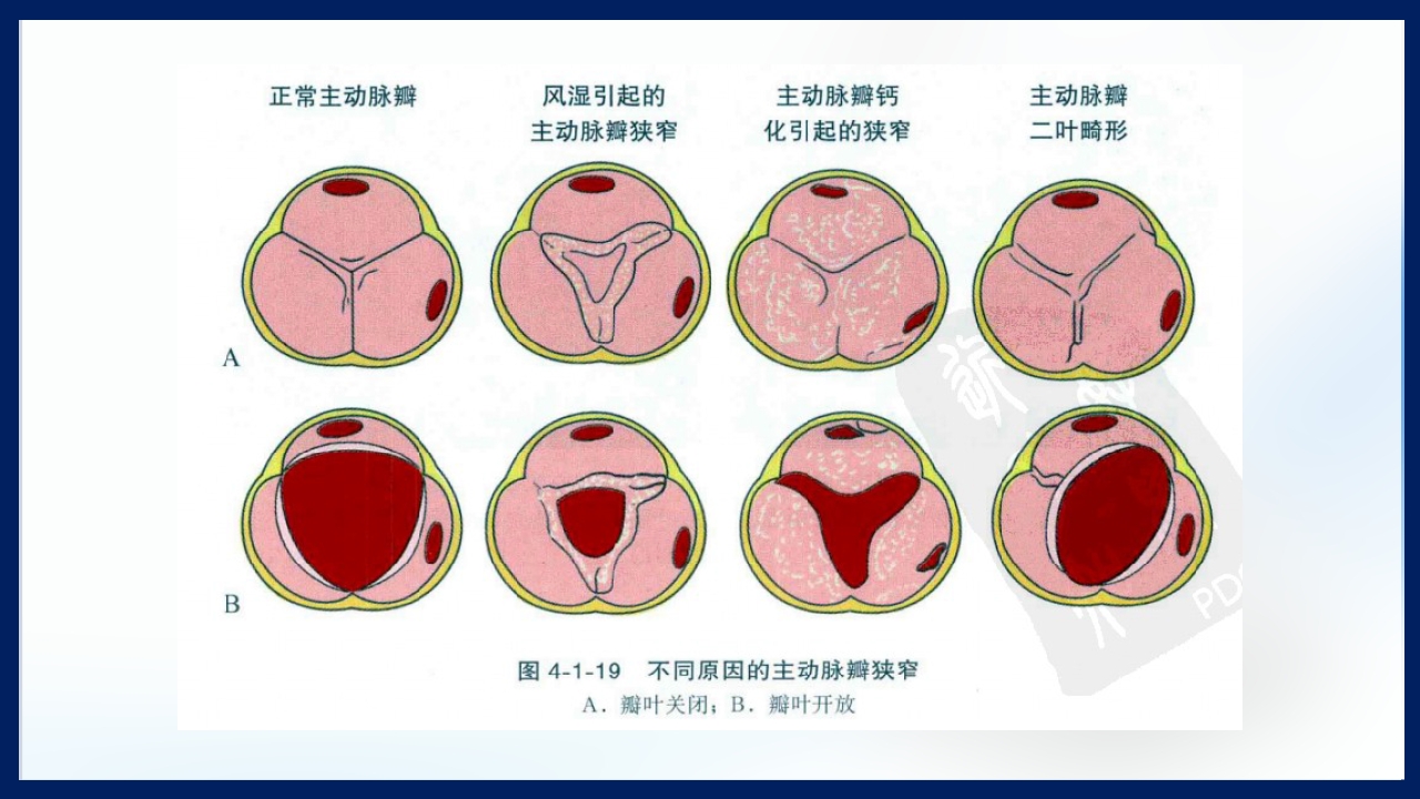 心脏瓣膜病PPT课件下载62